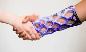 การเข้าเฝือก แบบใหม่ Cast21